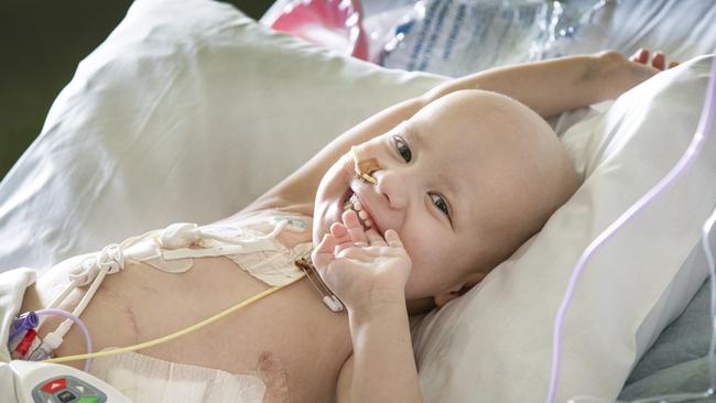 Oli Pluelkhahn, 3, endured a 10-hour surgery. Picture: David Caird