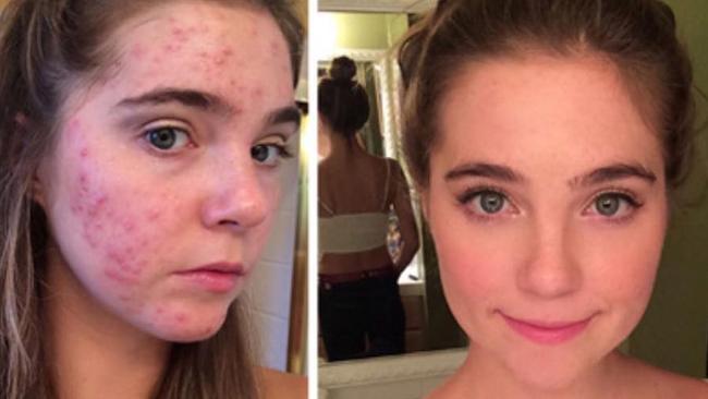 Twin sisters Nina and Randa Nelson both developed severe acne at the end of their teenage years.
