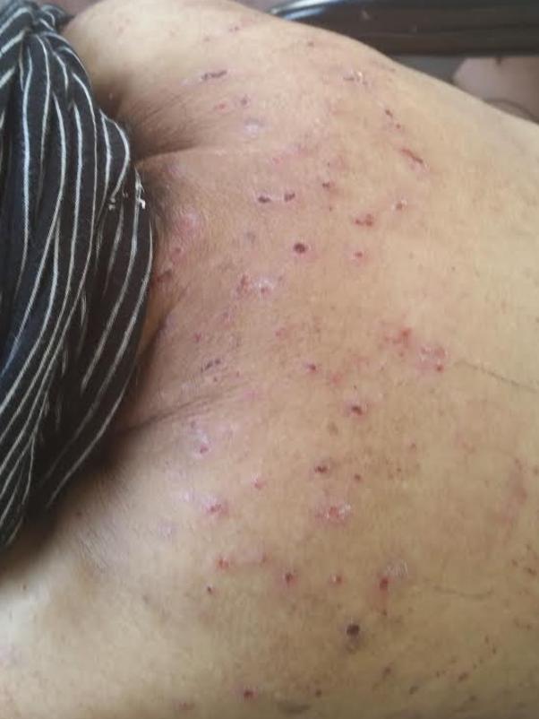 Isabel Norvill’s back is covered with scabies. Picture: Supplied