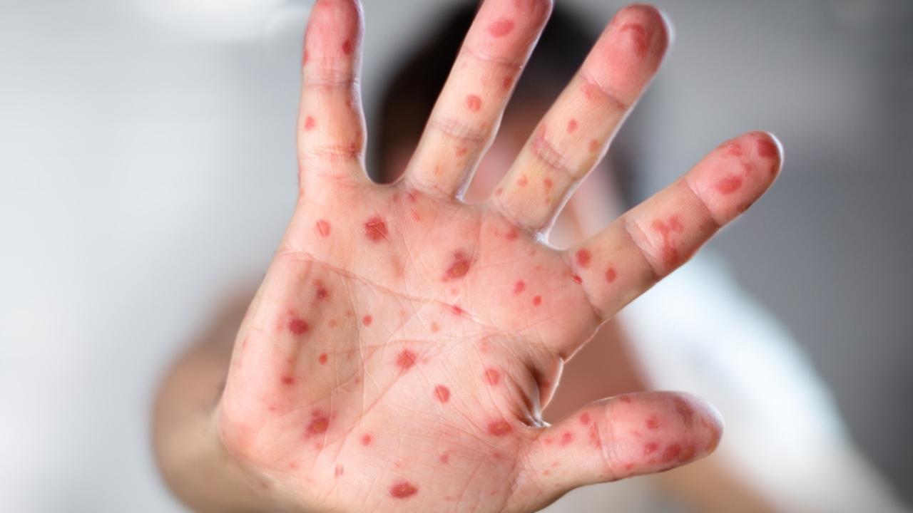 hand-foot-mouth-disease-cairns-and-tablelands-childcare-centres