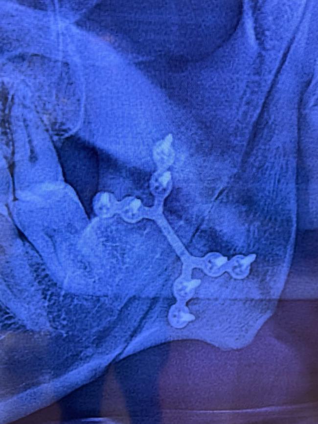 Hayes shared a photo of his swollen jaw and X-ray imagery on Instagram.