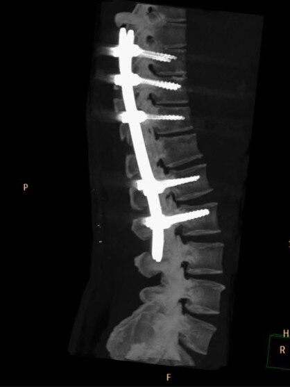 Mark Berridge’s spine x-ray after his accident.