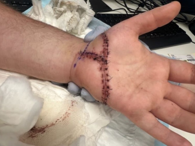 An NDIS participant needed 41 stitches after a machete attack.