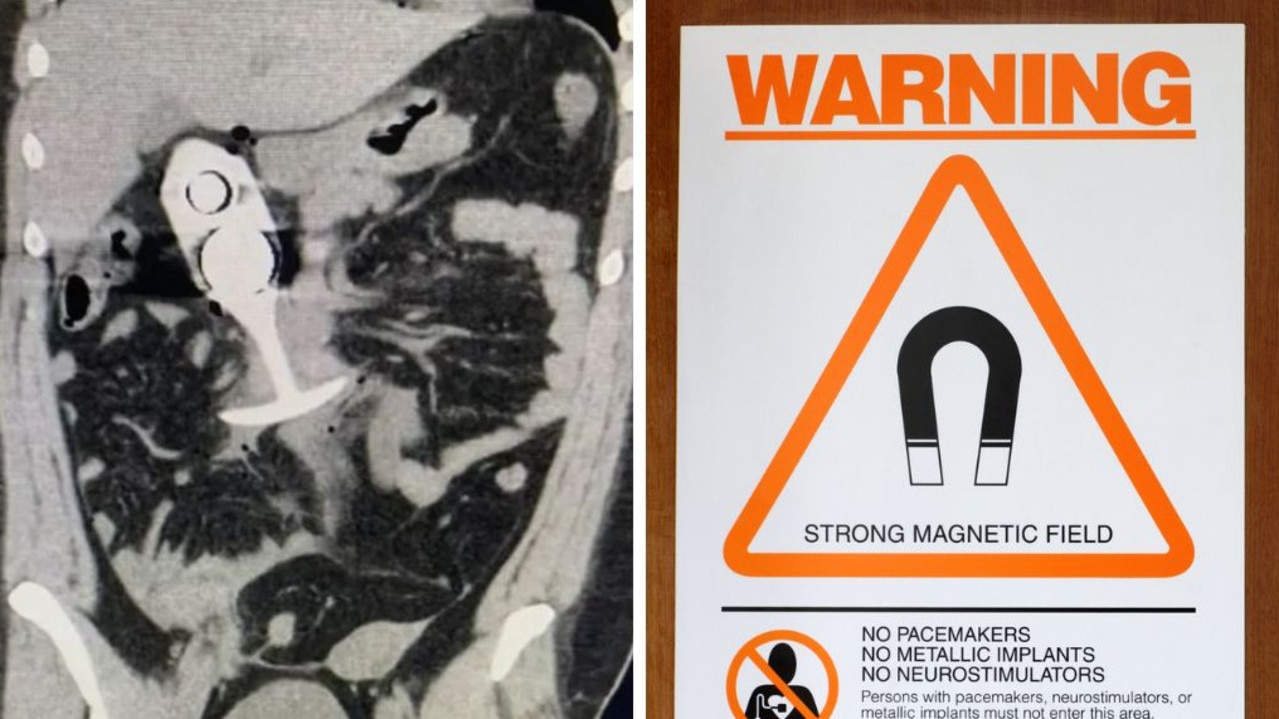 MRI scan shows horror sex toy mistake