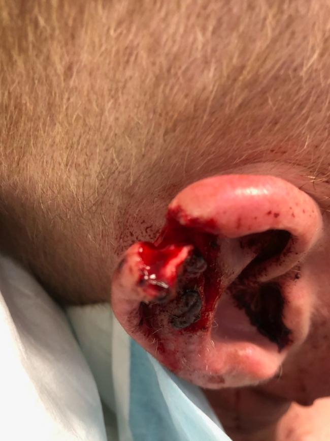 GRAPHIC WARNING: Mr Millington is accused of biting the ear of an off-duty police officer, leaving him with significant injuries.