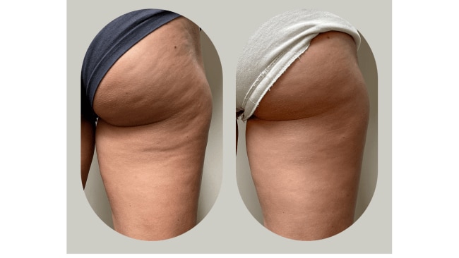 Before and after using the Body Sculpt Cup. Image: Supplied