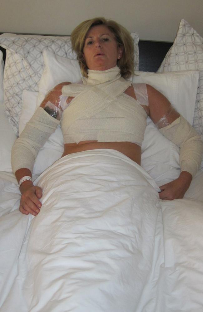 Adele Wishart after being injured by soup cooking in a Thermomix. Picture: Supplied