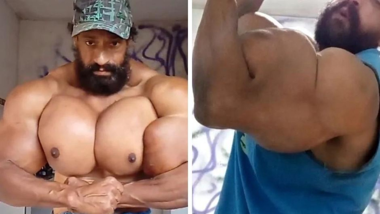 Il s'injecte du Synthol pour ressembler à Hulk et frôle l'amputation 