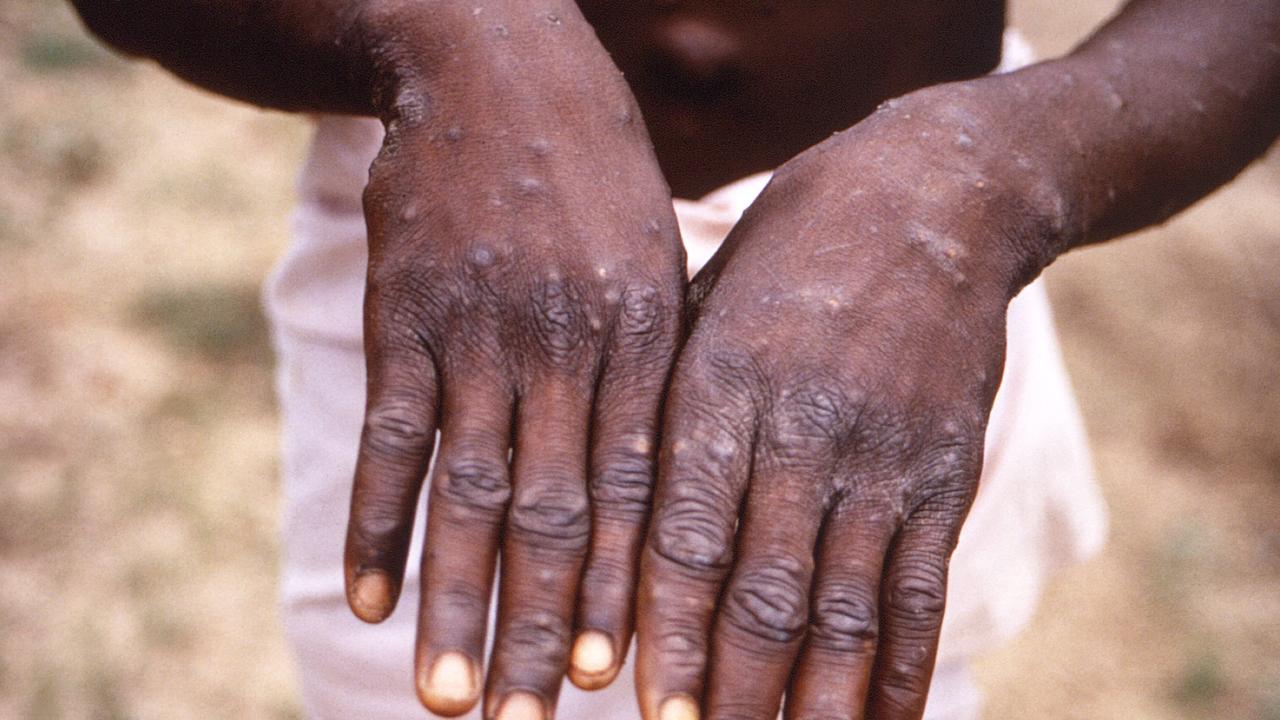 An image of a monkeypox case in a patient, featured in a handout photo provided by the Centers for Disease Control and Prevention. A second case of monkeypox has been identified in NSW. Picture: Brian W.J. Mahy / Centers for Disease Control and Prevention / AFP