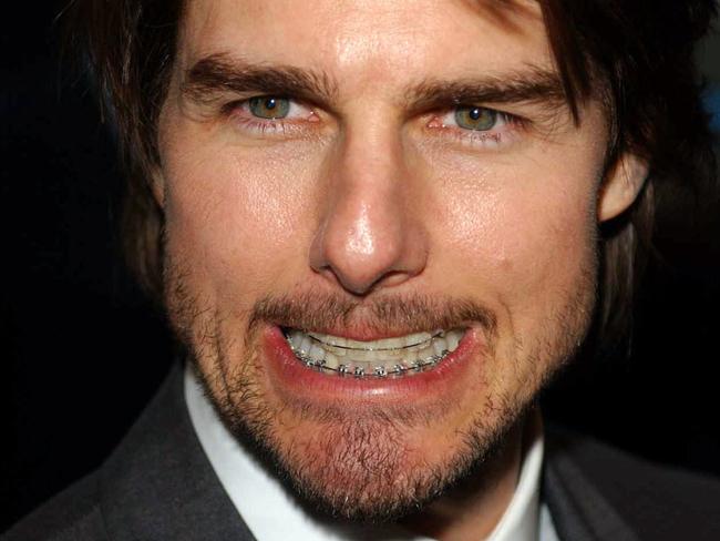 Tom Cruise at the London premiere of his film Minority Report in 2002, sporting a full set of braces. Picture: AP PicMyung/Jung/Kim