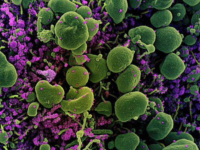 A colorised scanning electron micrograph of an apoptotic cell (green) heavily infected with SARS-CoV-2 virus particles (purple), isolated from a patient sample. Picture: AFP