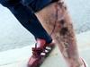‘Disfiguring people’: Rise of grim street drug