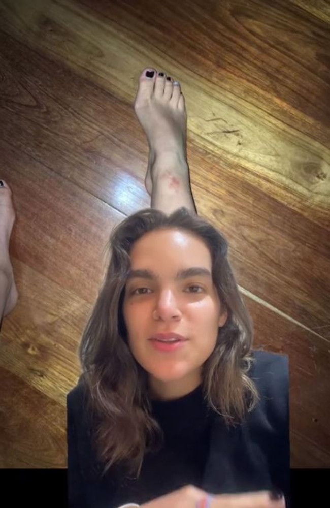 Marystella was told the parasite she had was called cutaneous larva migrans, or hookworm, and is usually transmitted via animal faeces. Picture: Jam Press