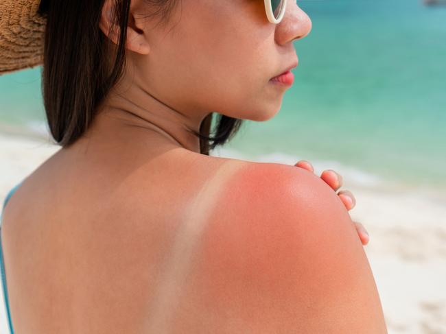 Sunburned skin on shoulder of a woman because of not using cream with sunscreen protection. Red skin sun burn after Sunbathing at the beach. Summer and holiday concept