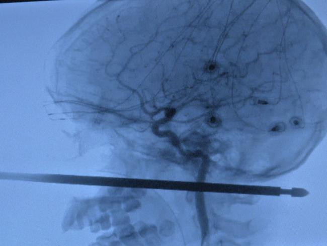 This image courtesy of Medical News Network, shows an X-Ray of  Xavier Cunningham, 10, after a meat skewer impaled his skull on September 8, 2018, but missed his brain, in what medics called a "one in a million" accident. - "This thing had spared the eye, spared the brain, spared the spinal cord," neurosurgeon Koji Ebersole, head of the local university health authority, told the Kansas City Star. Ebersole said the skewer managed to pass through a tiny space in his head surrounded by major blood vessels. "I have not seen anything passed to that depth in a situation that was survivable, let alone one where we think the recovery will be near complete if not complete," Ebersole said. (Photo by HO / Medical News Network / AFP) / RESTRICTED TO EDITORIAL USE - MANDATORY CREDIT "AFP PHOTO / Medical News Network" - NO MARKETING NO ADVERTISING CAMPAIGNS - DISTRIBUTED AS A SERVICE TO CLIENTS