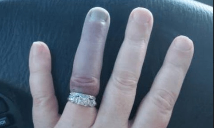 Wedding Ring Turns Finger Blue Internet Fears She Ll Need To