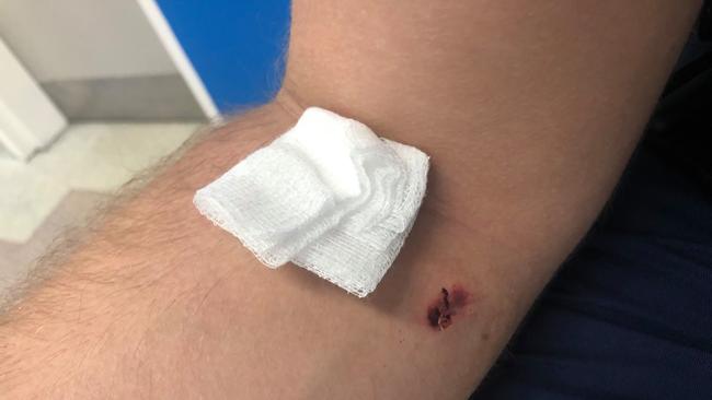 A policeman was hospitalised after a man bit him at a fast food outlet in Minchinbury. The image above is of the bite mark left on the officer. Picture: Supplied