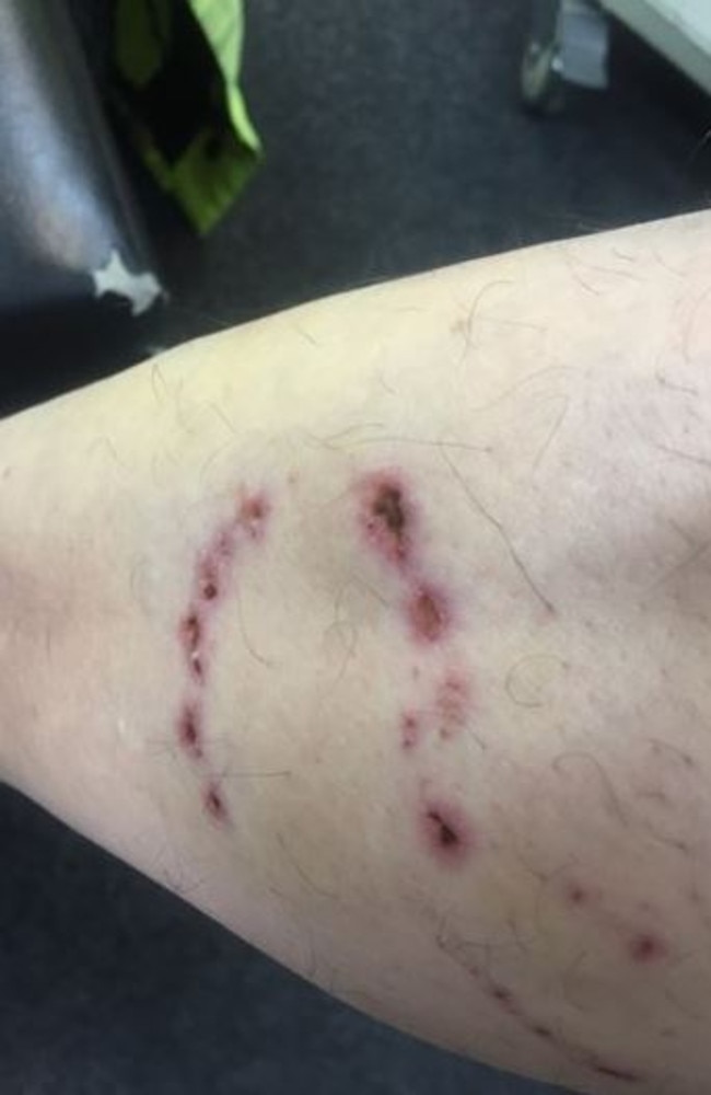 The bite marks left on a Victorian postie. Picture: Supplied.