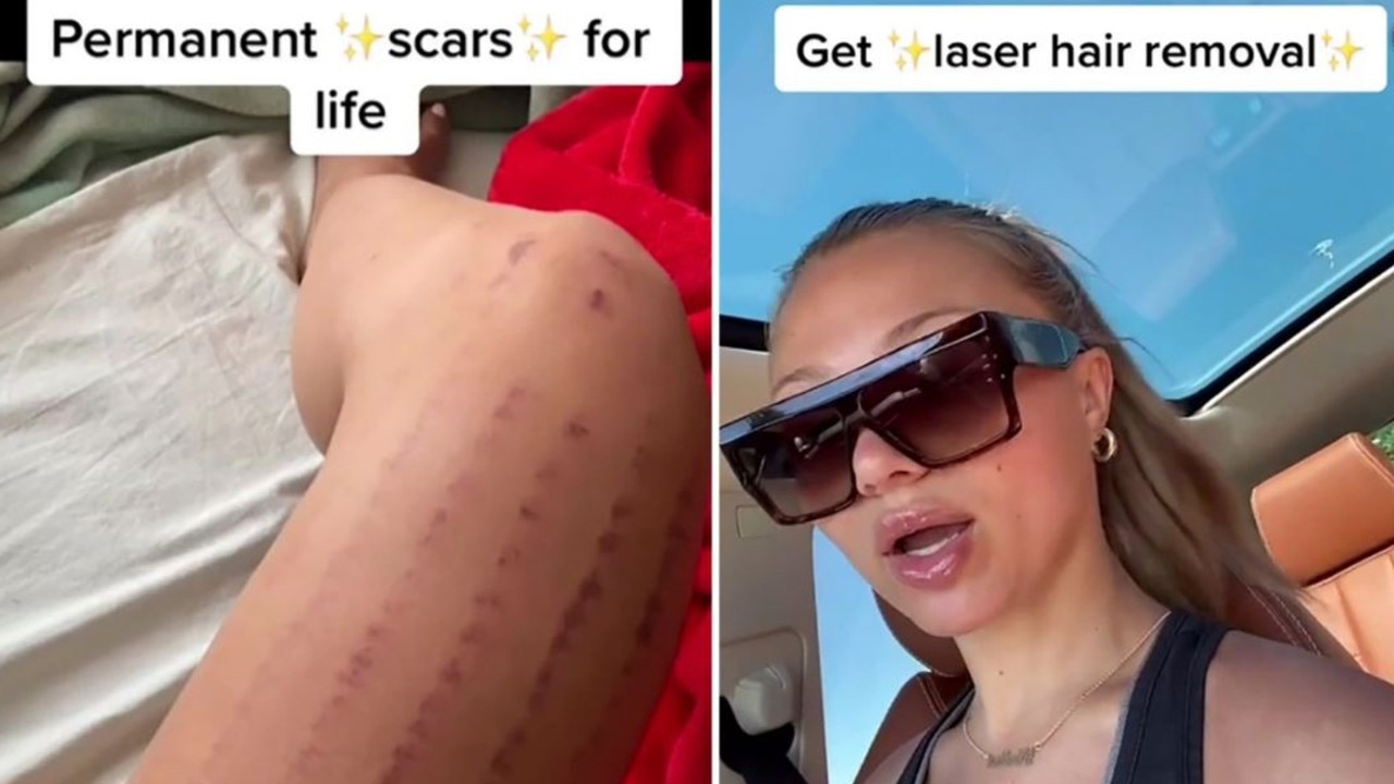 Laser hair removal disaster leaves woman with permanent scars