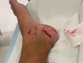 Tradie Tim McAndrew was the second person within an hour to be bitten by a shark at Crowdy Bay, Sydney. Picture: Nine News,