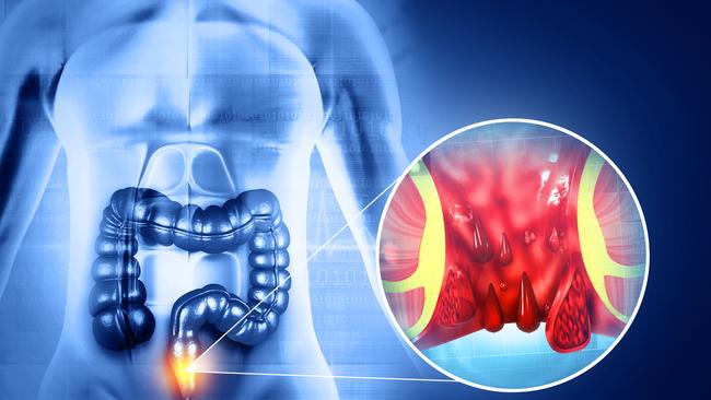 Haemorrhoids (piles). Picture: iStock