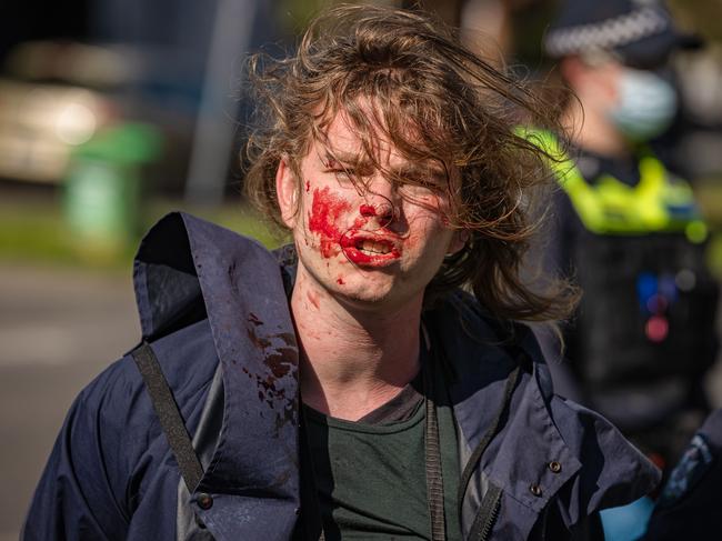 A bloodied protester. Picture: Jason Edwards