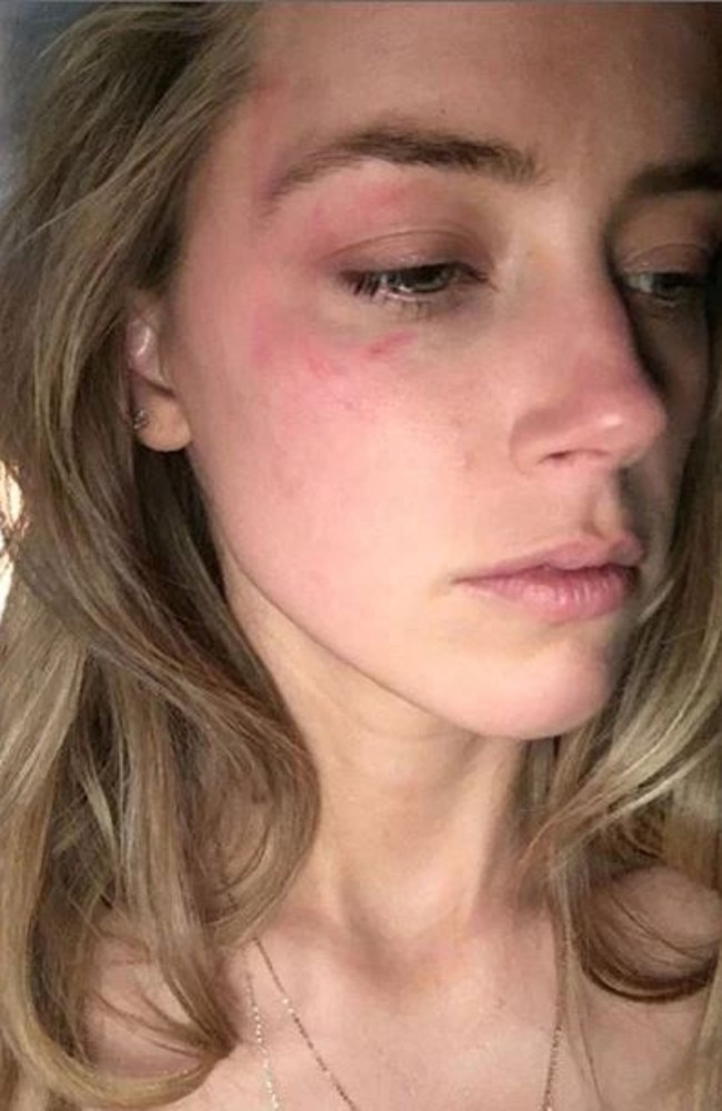 Amber Heard shows bruising under her right eye in this 2016 court filing.