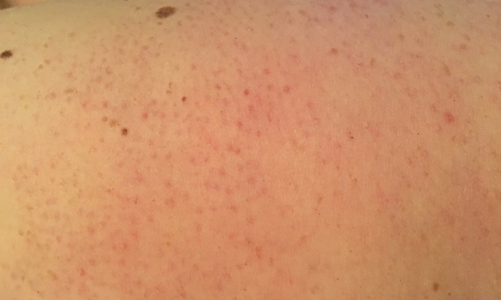 Chicken Skin Keratosis Pilaris How To Get Rid Of Tiny Red Dots On Arms Kidspot