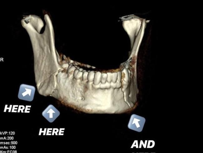 Jordan Kahu has broken his jaw in three places. Picture: Instagram