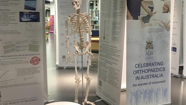 Skeleton stolen from orthopaedic exhibition at Adelaide City Library. Picture: Supplied