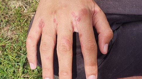 Scabies is a treatable infectious skin condition caused by tiny mites. Picture: Getty