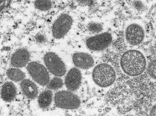 This undated electron microscopic (EM) handout image provided by the Centers for Disease Control and Prevention depicts a monkeypox virion, obtained from a clinical sample associated with the 2003 prairie dog outbreak. - It was a thin section image from a human skin sample. On the left were mature, oval-shaped virus particles, and on the right were the crescents, and spherical particles of immature virions. (Photo by Cynthia S. Goldsmith / Centers for Disease Control and Prevention / AFP) / RESTRICTED TO EDITORIAL USE - MANDATORY CREDIT "AFP PHOTO / Cynthia S. Goldsmith / Centers for Disease Control and Prevention " - NO MARKETING - NO ADVERTISING CAMPAIGNS - DISTRIBUTED AS A SERVICE TO CLIENTS