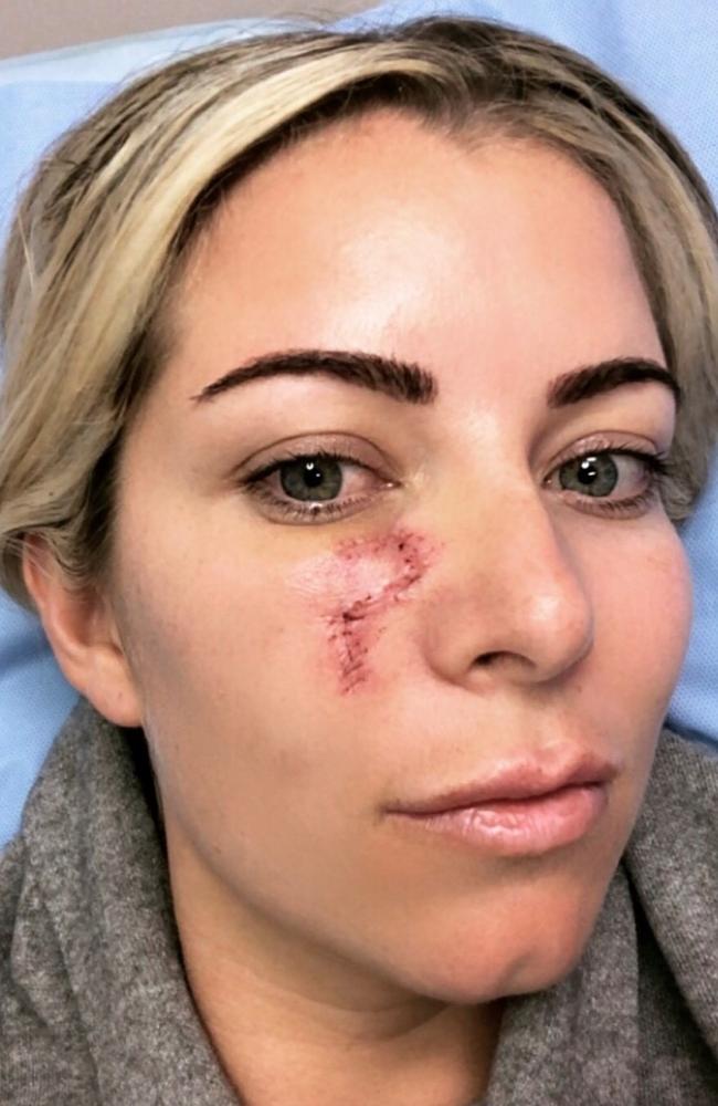 Kirstie Webster said she was shocked to discover a blind pimple under her eye was, in fact, skin cancer. Picture: Supplied
