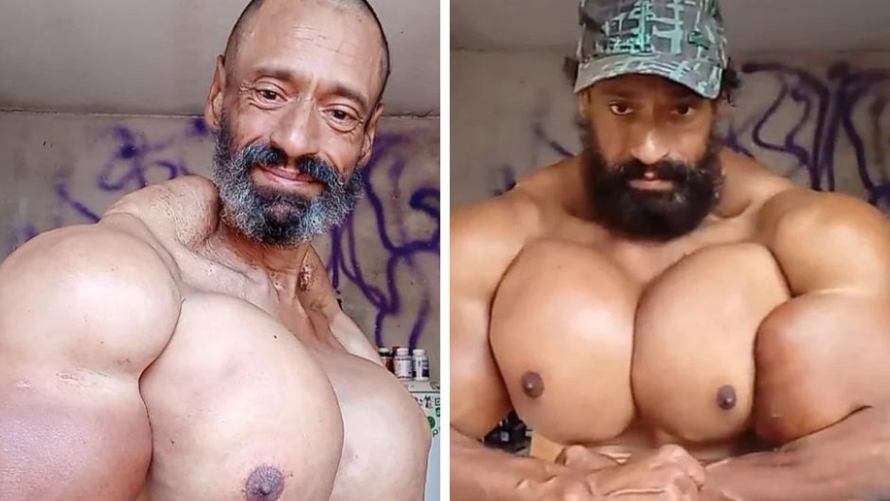 Synthol Man Says He Wants The Biggest Arms In The World