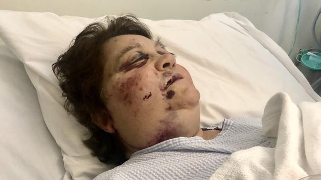 Penelope Katsavos was left bloodied and bruised after the horrific attack.