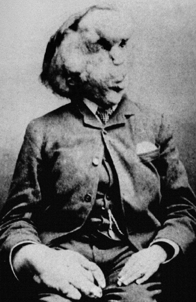 Joseph Merrick was a healthy baby until the age of 21 months when his lips began to swell. Picture: Alamy