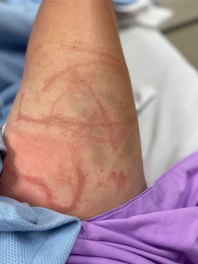 The injuries to a woman's leg after she was stung by a box jellyfish at Rowes Bay.