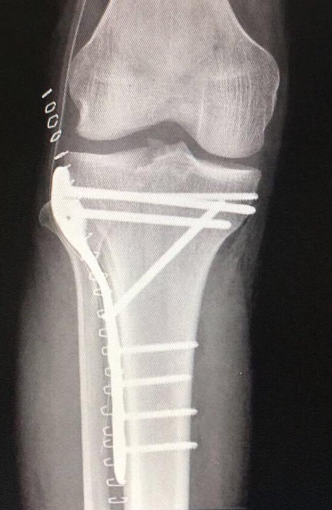 X-ray of Miller's fractured leg. Picture: supplied