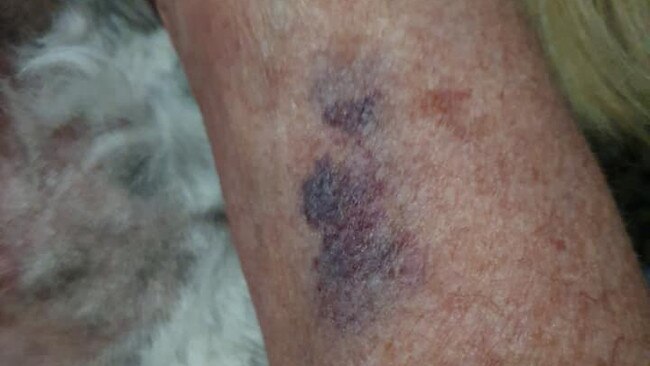 The victims of the alleged dog attack suffered bruising. Picture: Supplied