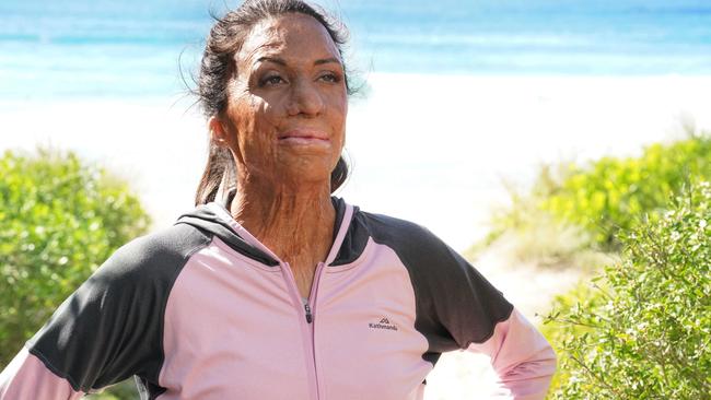 Turia Pitt spent over six months in hospital due to fire-related injuries. Picture: Andy Baker