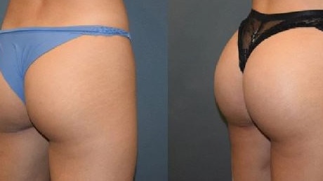 Experts warn against Brazilian Butt Lifts (BBL) despite its growing popularity – a 19 per cent increase in procedures in 2019. Picture: Supplied