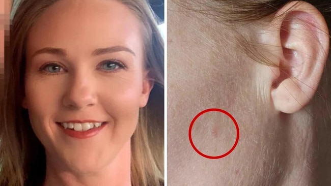 A mum has urged Aussies to stay up to date with their skin checks after a “pimple” led to a cancer diagnosis.