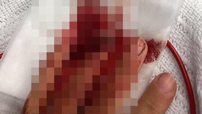 The woman’s finger was partially amputated. Picture: Supplied