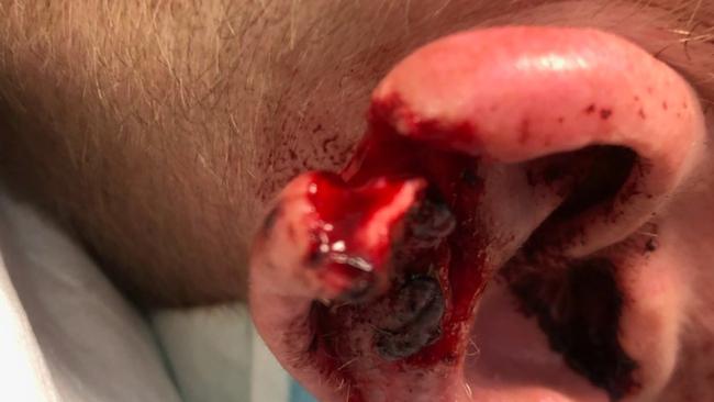 GRAPHIC WARNING: Millington was found guilty of biting the ear of an off-duty police officer, leaving him with significant injuries.