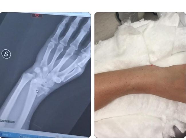 Sally Pearson's x-ray of her broken wrist.