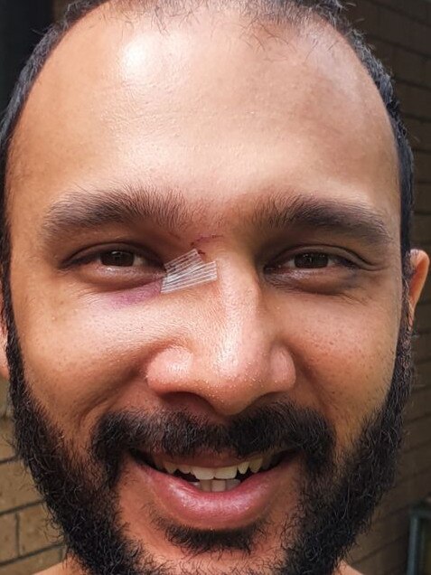 Gabba Ward Councillor Jonathan Sriranganathan shared an image of injuries he said were sustained from a punch.
