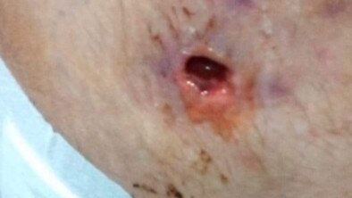 The wound which has led to a 12-year-old homeless Gold Coast girl seeking hospital treatment before being released.