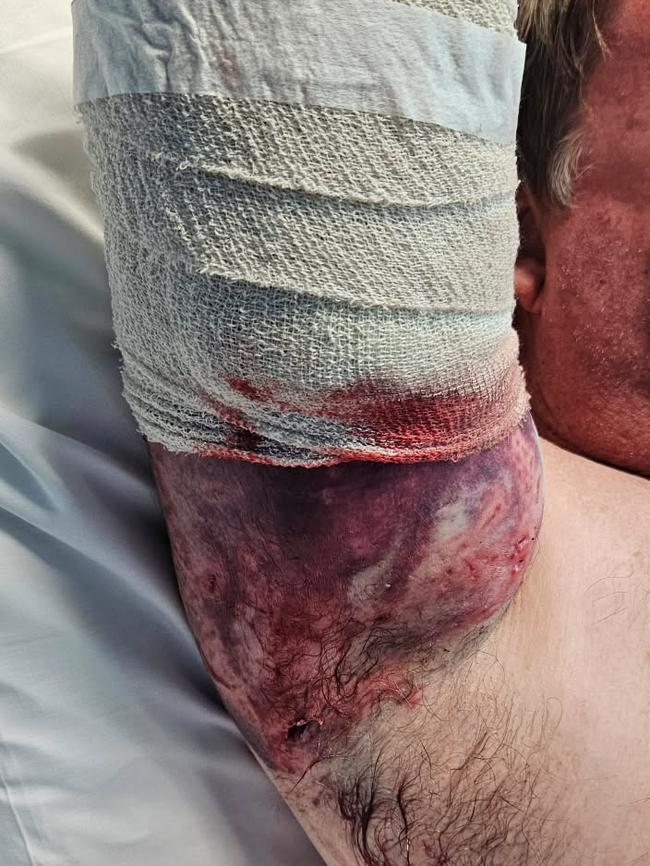 Brett Grant sustained a total of 13 serious bites, including two to the right bicep as he protected his throat. Picture: Supplied