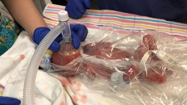 Tiny Rafferty weighed just 704 grams when he was born. Picture: supplied.