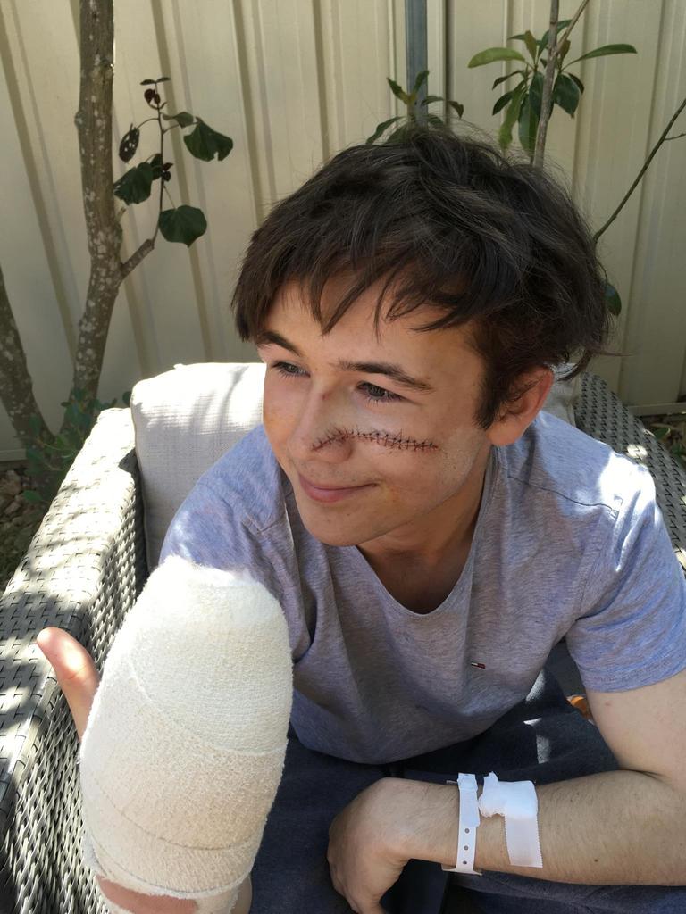 Jake Elias' stitches after being attacked with an axe in the CBD. Photo: Supplied